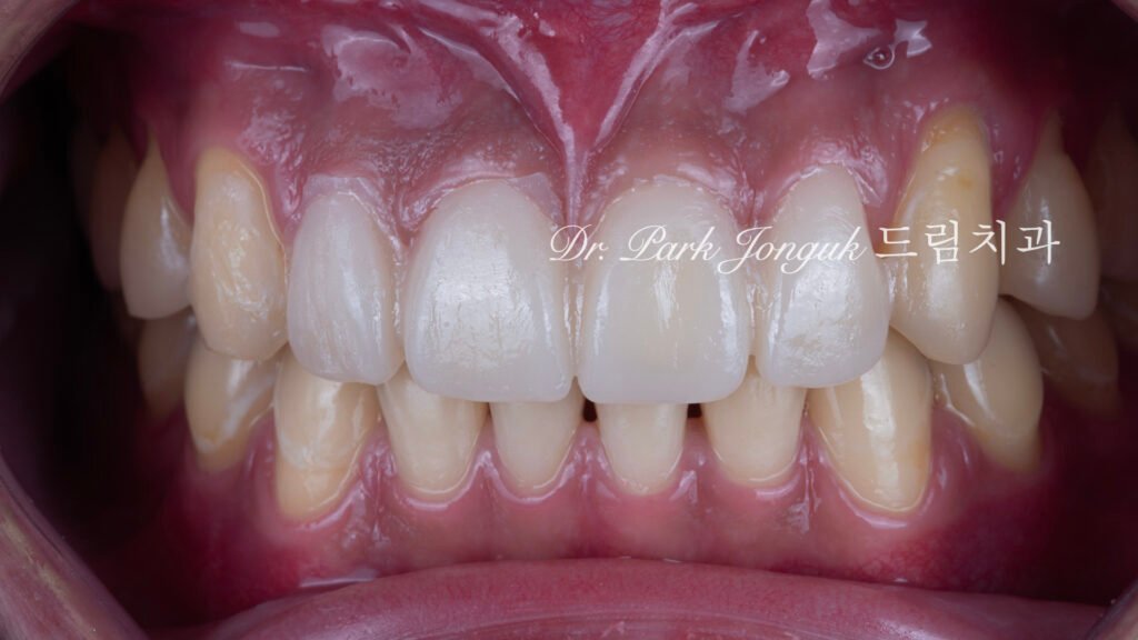 깨진 치아 라미네이트, Laminate for Fractured Teeth, 부식된 치아, Eroded Teeth, 역류성 식도염, GERD, 샌드위치 테크닉, Sandwich Technique, 무삭제 라미네이트, No-Prep Laminate, 교정 후 라미네이트, Post-Orthodontic Laminate