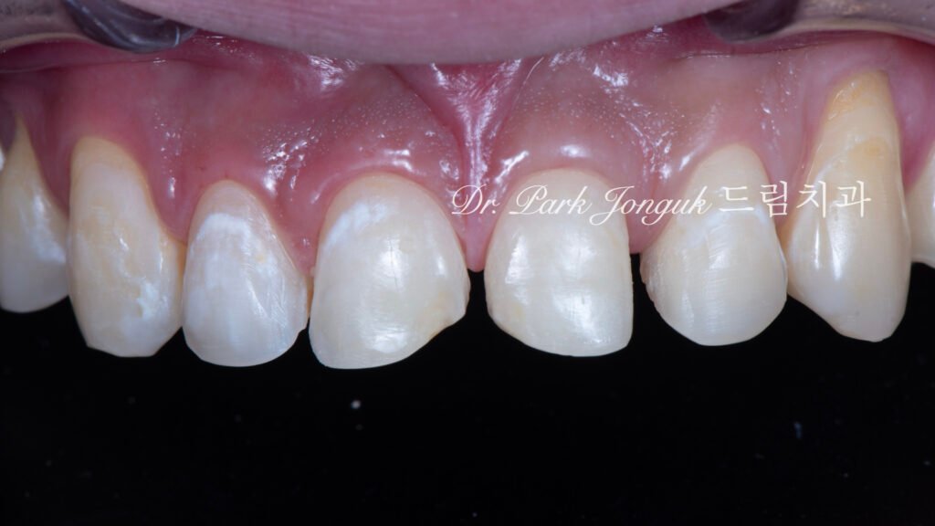 깨진 치아 라미네이트, Laminate for Fractured Teeth, 부식된 치아, Eroded Teeth, 역류성 식도염, GERD, 샌드위치 테크닉, Sandwich Technique, 무삭제 라미네이트, No-Prep Laminate, 교정 후 라미네이트, Post-Orthodontic Laminate