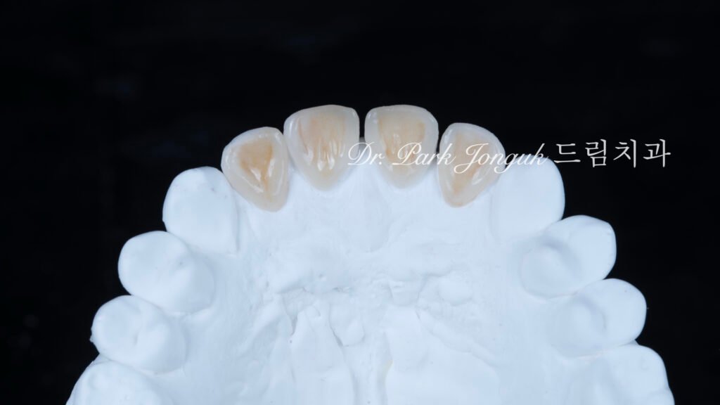 깨진 치아 라미네이트, Laminate for Fractured Teeth, 부식된 치아, Eroded Teeth, 역류성 식도염, GERD, 샌드위치 테크닉, Sandwich Technique, 무삭제 라미네이트, No-Prep Laminate, 교정 후 라미네이트, Post-Orthodontic Laminate