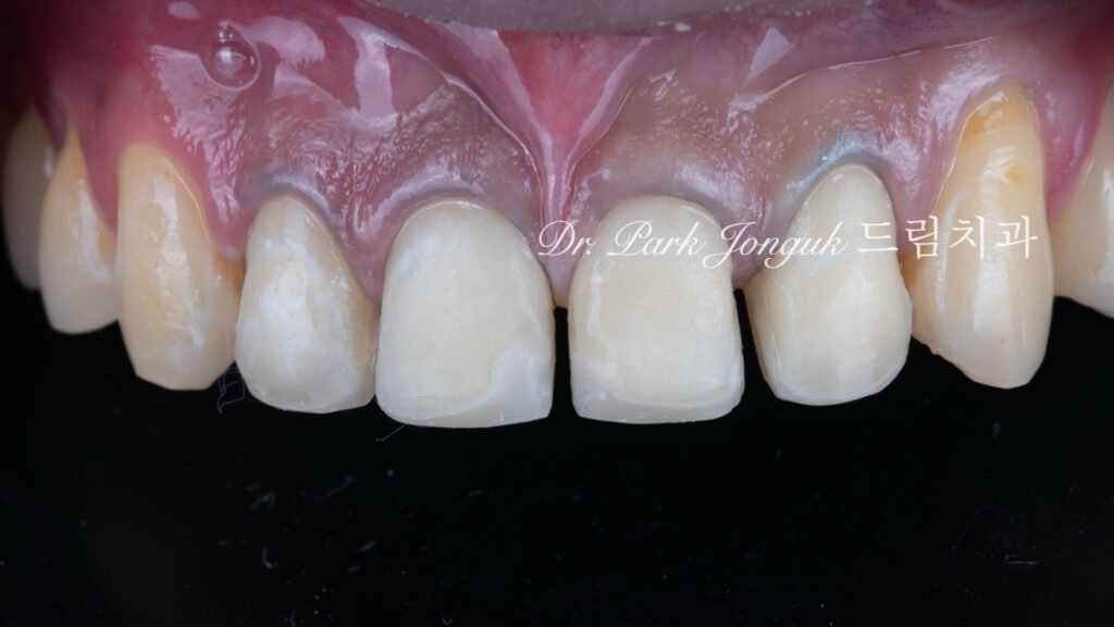 깨진 치아 라미네이트, Laminate for Fractured Teeth, 부식된 치아, Eroded Teeth, 역류성 식도염, GERD, 샌드위치 테크닉, Sandwich Technique, 무삭제 라미네이트, No-Prep Laminate, 교정 후 라미네이트, Post-Orthodontic Laminate