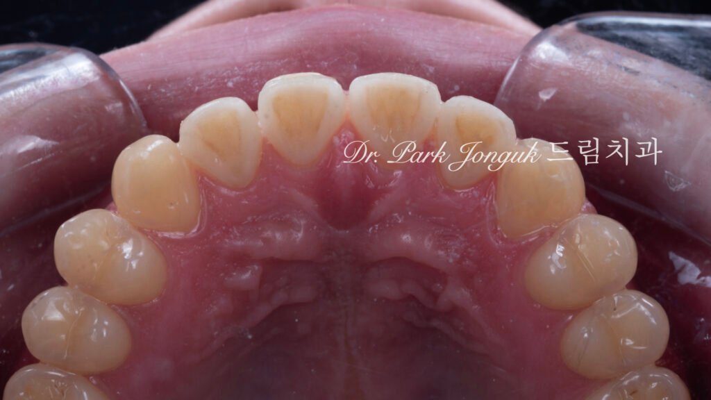 깨진 치아 라미네이트, Laminate for Fractured Teeth, 부식된 치아, Eroded Teeth, 역류성 식도염, GERD, 샌드위치 테크닉, Sandwich Technique, 무삭제 라미네이트, No-Prep Laminate, 교정 후 라미네이트, Post-Orthodontic Laminate