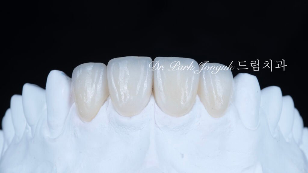 깨진 치아 라미네이트, Laminate for Fractured Teeth, 부식된 치아, Eroded Teeth, 역류성 식도염, GERD, 샌드위치 테크닉, Sandwich Technique, 무삭제 라미네이트, No-Prep Laminate, 교정 후 라미네이트, Post-Orthodontic Laminate