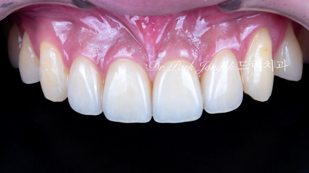 깨진 치아 라미네이트, Laminate for Fractured Teeth, 부식된 치아, Eroded Teeth, 역류성 식도염, GERD, 샌드위치 테크닉, Sandwich Technique, 무삭제 라미네이트, No-Prep Laminate, 교정 후 라미네이트, Post-Orthodontic Laminate