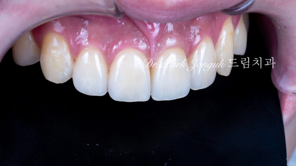 깨진 치아 라미네이트, Laminate for Fractured Teeth, 부식된 치아, Eroded Teeth, 역류성 식도염, GERD, 샌드위치 테크닉, Sandwich Technique, 무삭제 라미네이트, No-Prep Laminate, 교정 후 라미네이트, Post-Orthodontic Laminate