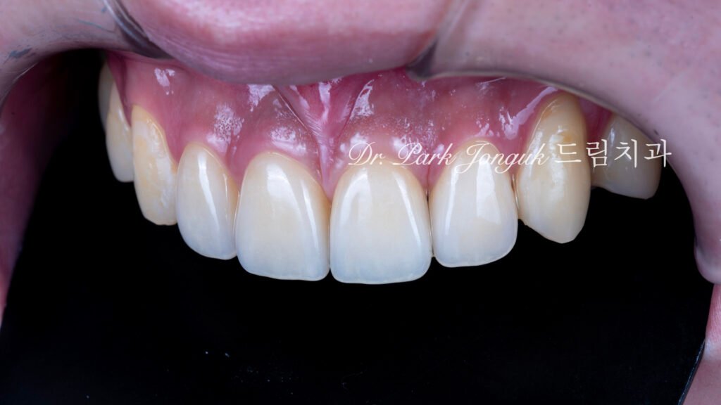 깨진 치아 라미네이트, Laminate for Fractured Teeth, 부식된 치아, Eroded Teeth, 역류성 식도염, GERD, 샌드위치 테크닉, Sandwich Technique, 무삭제 라미네이트, No-Prep Laminate, 교정 후 라미네이트, Post-Orthodontic Laminate