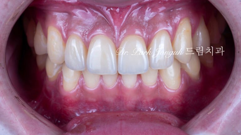 깨진 치아 라미네이트, Laminate for Fractured Teeth, 부식된 치아, Eroded Teeth, 역류성 식도염, GERD, 샌드위치 테크닉, Sandwich Technique, 무삭제 라미네이트, No-Prep Laminate, 교정 후 라미네이트, Post-Orthodontic Laminate