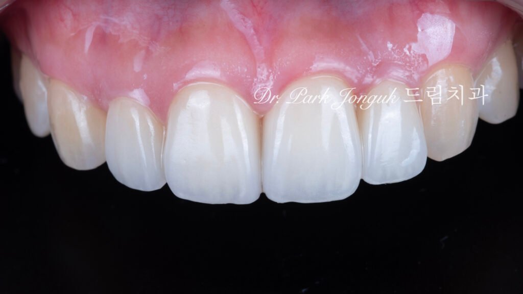 앞니 라미네이트, Anterior Laminate, 라미네이트 잘하는 곳, Best Laminate Clinic, 라미네이트 종류, Types of Laminate, 라미네이트 제작 과정, Laminate Fabrication Process, 핸드메이드 빌드업, Hand-Layered Build-up, 원데이 라미네이트, One-Day Laminate