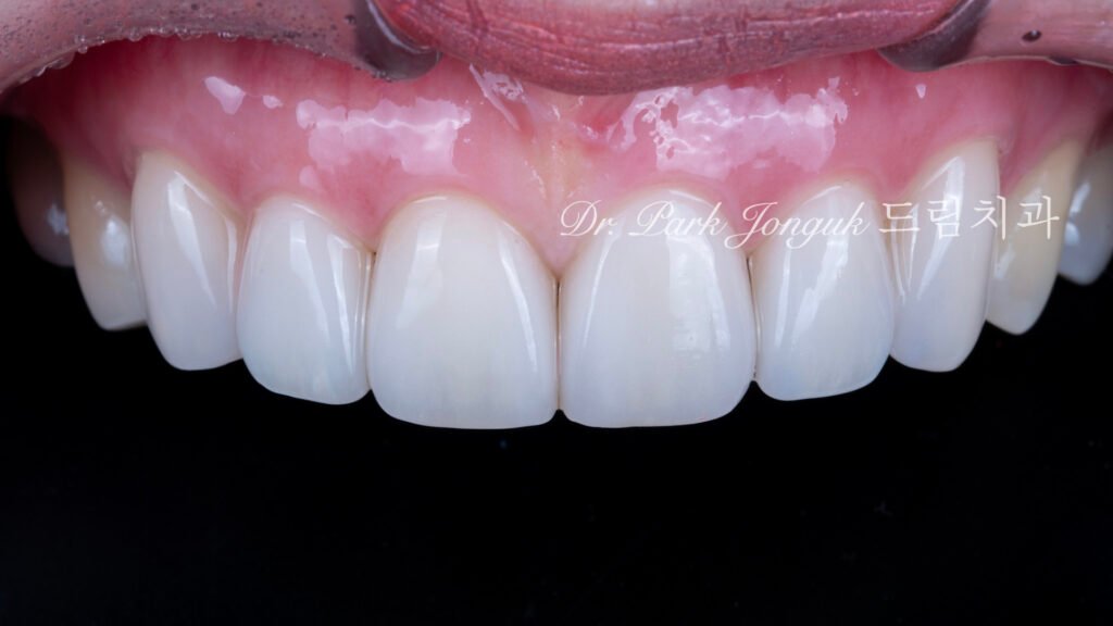 앞니 라미네이트, Anterior Laminate Veneer, 라미네이트 잘하는 곳, Expert Laminate Clinic, 자연스러운 라미네이트, Natural Laminate, 다층 빌드업, Multi-Layer Build-Up, 백금박 라미네이트, Platinum Foil Veneer