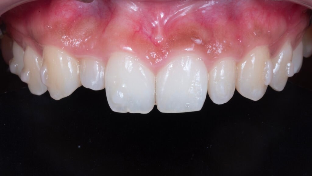 왜소치, Peg-Shaped Lateral Incisors, 왜소치 라미네이트, Peg Lateral Veneer, 무삭제 라미네이트, No-Prep Laminate, 인비절라인, Invisalign, 교정 후 라미네이트, Post-Orthodontic Veneer