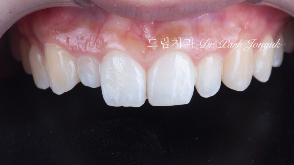 왜소치, Peg-Shaped Lateral Incisors, 왜소치 라미네이트, Peg Lateral Veneer, 무삭제 라미네이트, No-Prep Laminate, 인비절라인, Invisalign, 교정 후 라미네이트, Post-Orthodontic Veneer