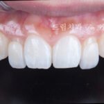 왜소치, Peg-Shaped Lateral Incisors, 왜소치 라미네이트, Peg Lateral Veneer, 무삭제 라미네이트, No-Prep Laminate, 인비절라인, Invisalign, 교정 후 라미네이트, Post-Orthodontic Veneer