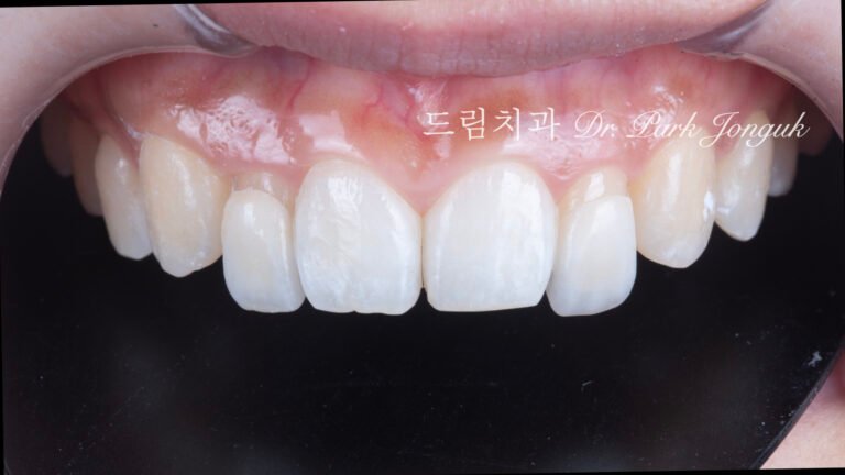 왜소치, Peg-Shaped Lateral Incisors, 왜소치 라미네이트, Peg Lateral Veneer, 무삭제 라미네이트, No-Prep Laminate, 인비절라인, Invisalign, 교정 후 라미네이트, Post-Orthodontic Veneer