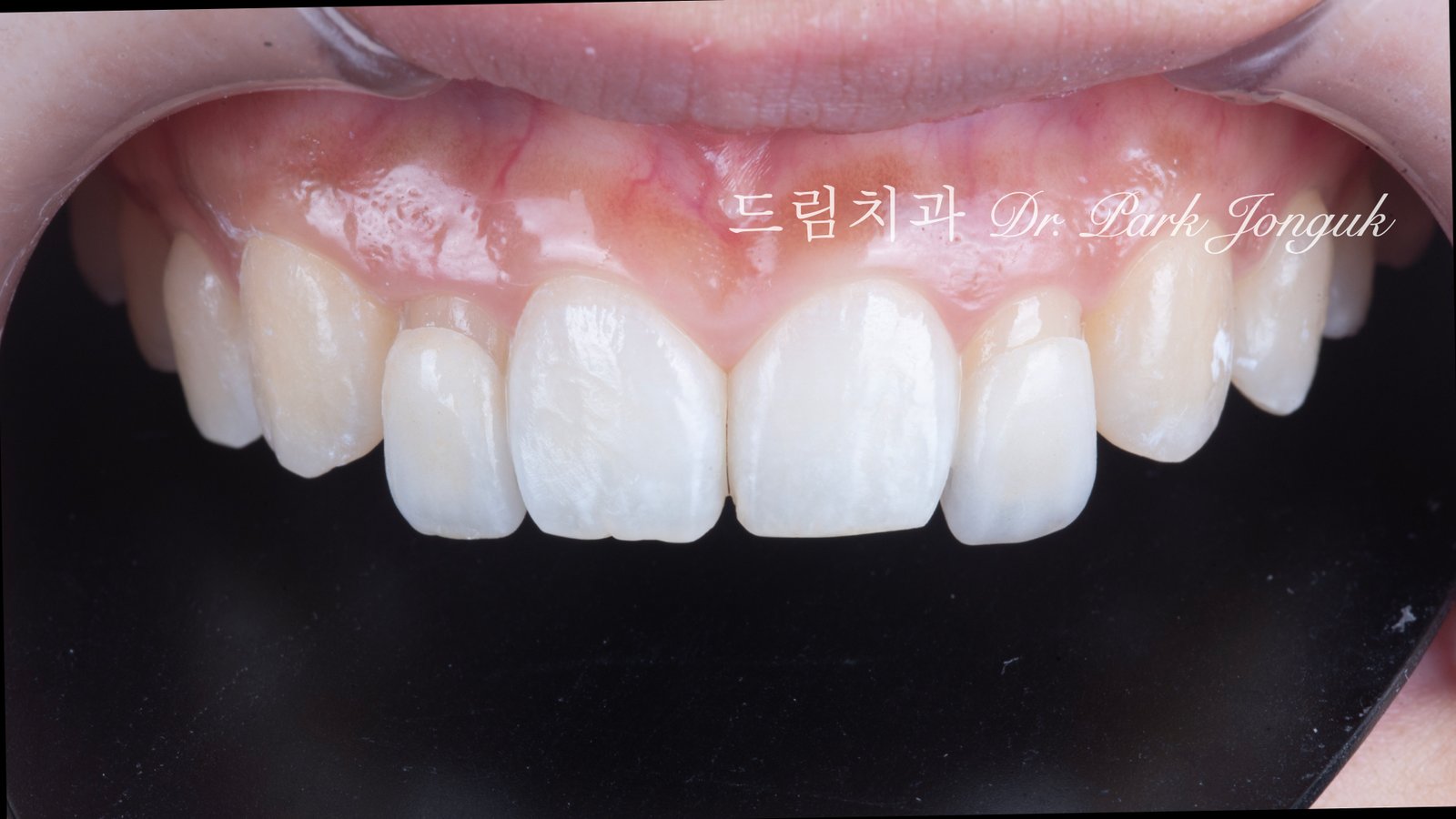 왜소치, Peg-Shaped Lateral Incisors, 왜소치 라미네이트, Peg Lateral Veneer, 무삭제 라미네이트, No-Prep Laminate, 인비절라인, Invisalign, 교정 후 라미네이트, Post-Orthodontic Veneer