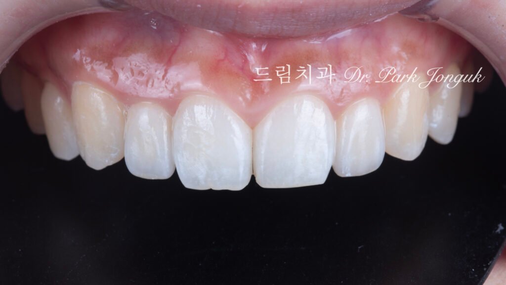 왜소치, Peg-Shaped Lateral Incisors, 왜소치 라미네이트, Peg Lateral Veneer, 무삭제 라미네이트, No-Prep Laminate, 인비절라인, Invisalign, 교정 후 라미네이트, Post-Orthodontic Veneer