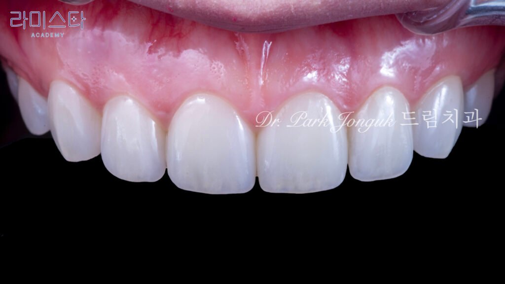앞니 라미네이트, Anterior Laminate Veneer, 라미네이트 잘하는 곳, Expert Laminate Clinic, 자연스러운 라미네이트, Natural Laminate, 다층 빌드업, Multi-Layer Build-Up, 백금박 라미네이트, Platinum Foil Veneer