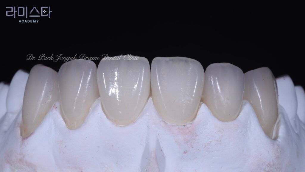 앞니 라미네이트, Anterior Laminate, 라미네이트 잘하는 곳, Best Laminate Clinic, 라미네이트 종류, Types of Laminate, 라미네이트 제작 과정, Laminate Fabrication Process, 핸드메이드 빌드업, Hand-Layered Build-up, 원데이 라미네이트, One-Day Laminate