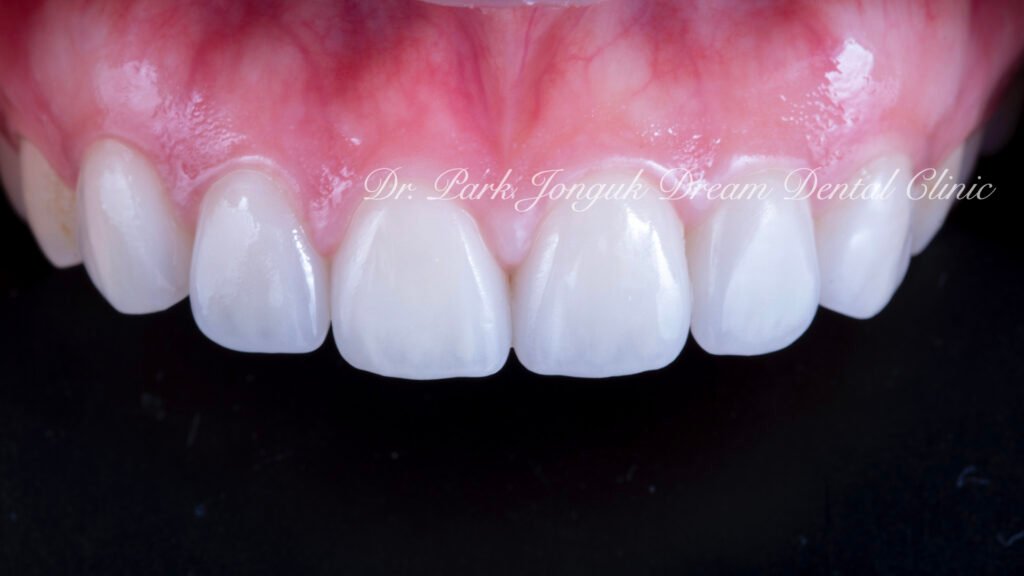 라미네이트 진단, Laminate Diagnosis, 정밀 진단, Precise Diagnosis, 얼굴 분석, Facial Analysis, 치아 비율, Tooth Proportion, 디지털 분석, Digital Analysis, 치료 예측, Treatment Prediction
