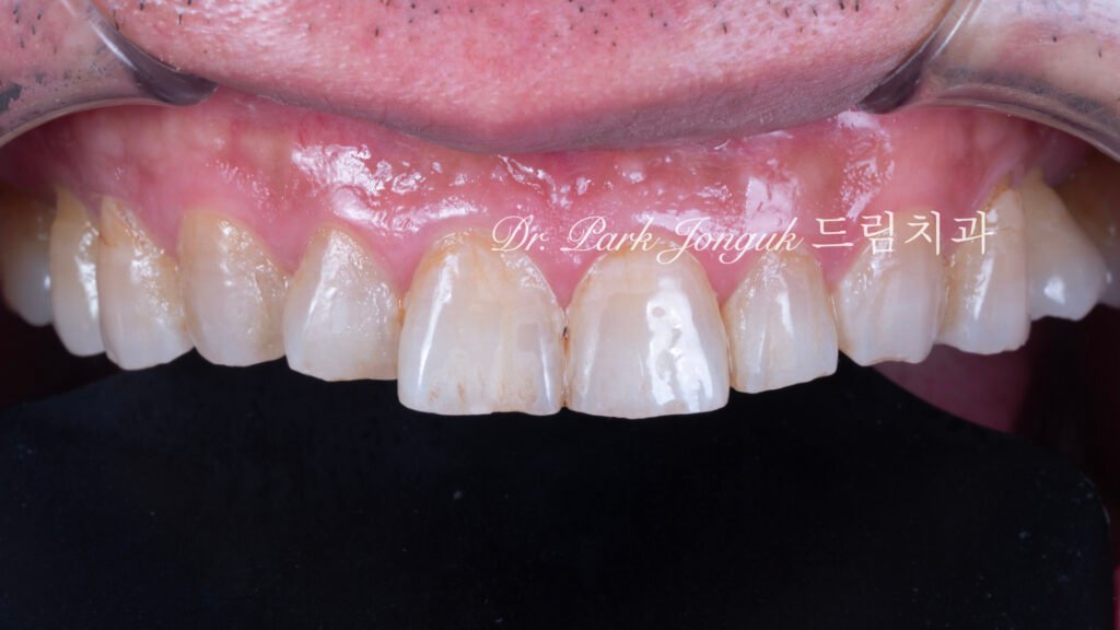 노화 치아 라미네이트, Aging Tooth Laminate, 50대 라미네이트, 60대 라미네이트, 법랑질 손실, Enamel Loss, Biomimetic, 생체모방 치과학, 치아 노화, Tooth Aging