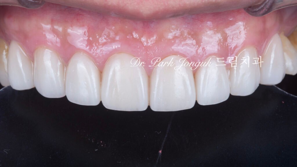 노화 치아 라미네이트, Aging Tooth Laminate, 50대 라미네이트, 60대 라미네이트, 법랑질 손실, Enamel Loss, Biomimetic, 생체모방 치과학, 치아 노화, Tooth Aging