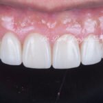 노화 치아 라미네이트, Aging Tooth Laminate, 50대 라미네이트, 60대 라미네이트, 법랑질 손실, Enamel Loss, Biomimetic, 생체모방 치과학, 치아 노화, Tooth Aging
