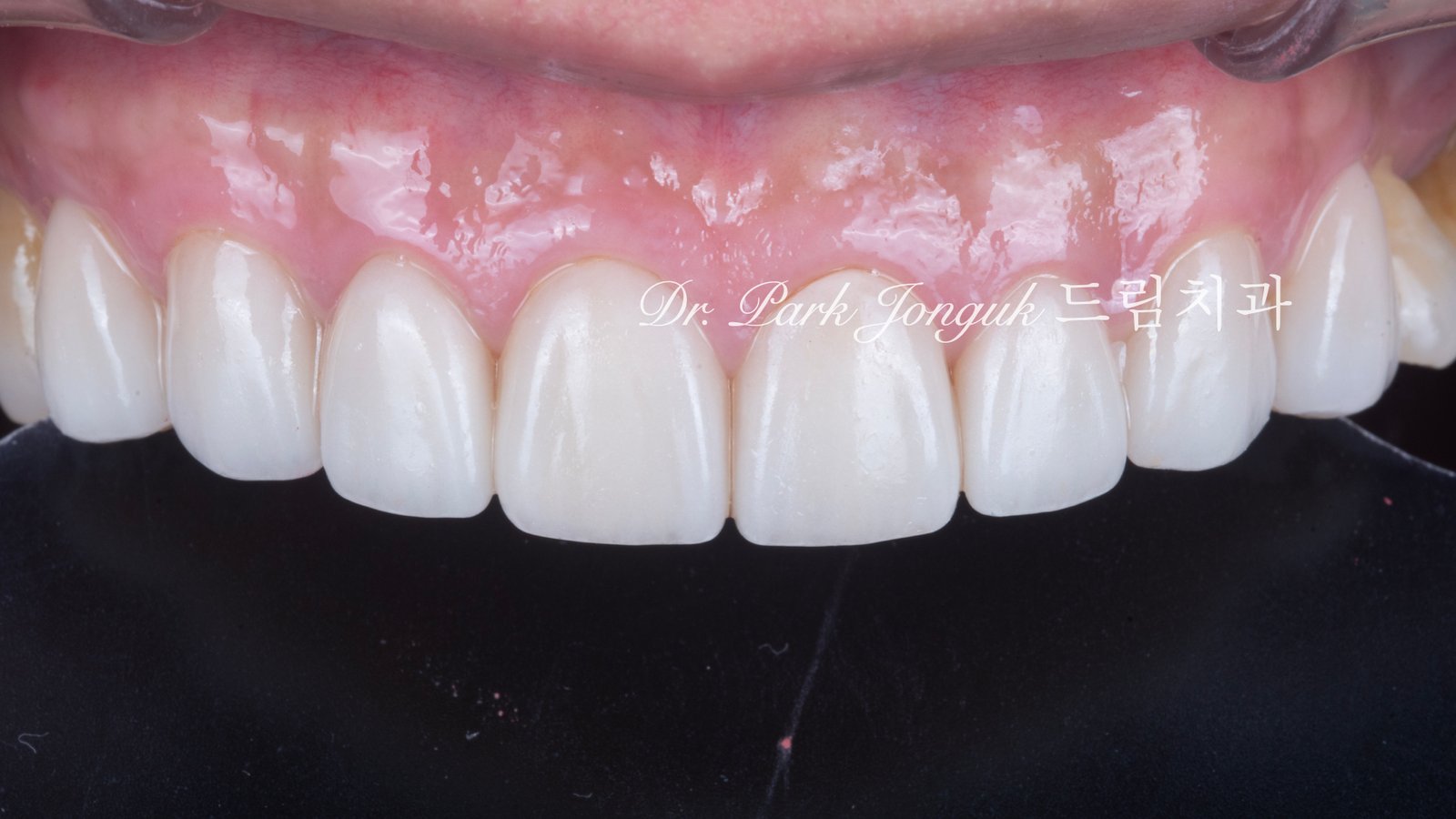 노화 치아 라미네이트, Aging Tooth Laminate, 50대 라미네이트, 60대 라미네이트, 법랑질 손실, Enamel Loss, Biomimetic, 생체모방 치과학, 치아 노화, Tooth Aging