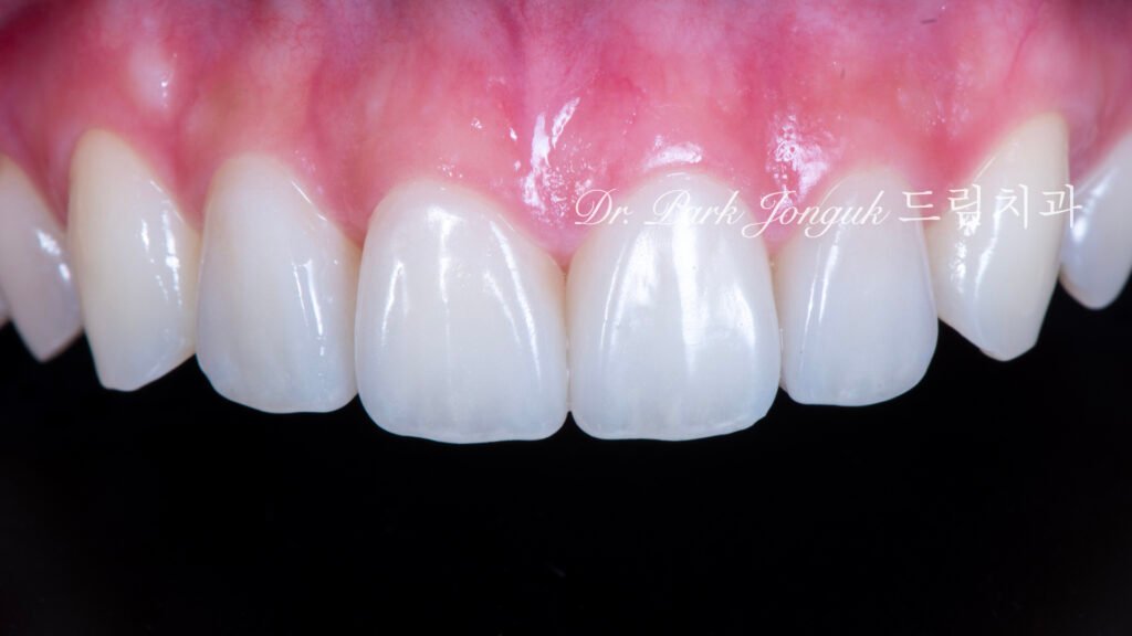 라미네이트 진단, Laminate Diagnosis, 정밀 진단, Precise Diagnosis, 얼굴 분석, Facial Analysis, 치아 비율, Tooth Proportion, 디지털 분석, Digital Analysis, 치료 예측, Treatment Prediction
