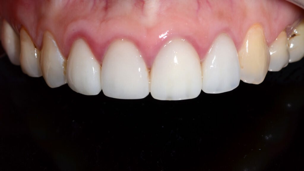 라미네이트 염증 생김