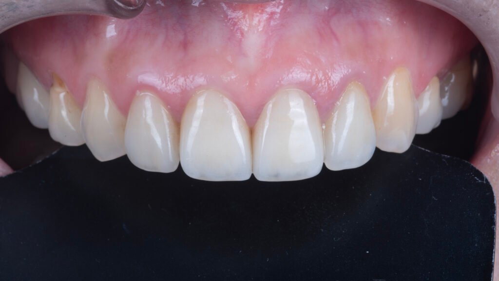 라미네이트 9년 경과