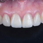 장기 유지되는 라미네이트