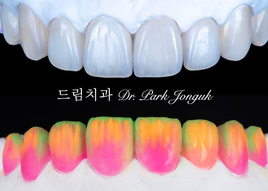 빌드업 과정이 들어가는 라미네이트 제작 과정