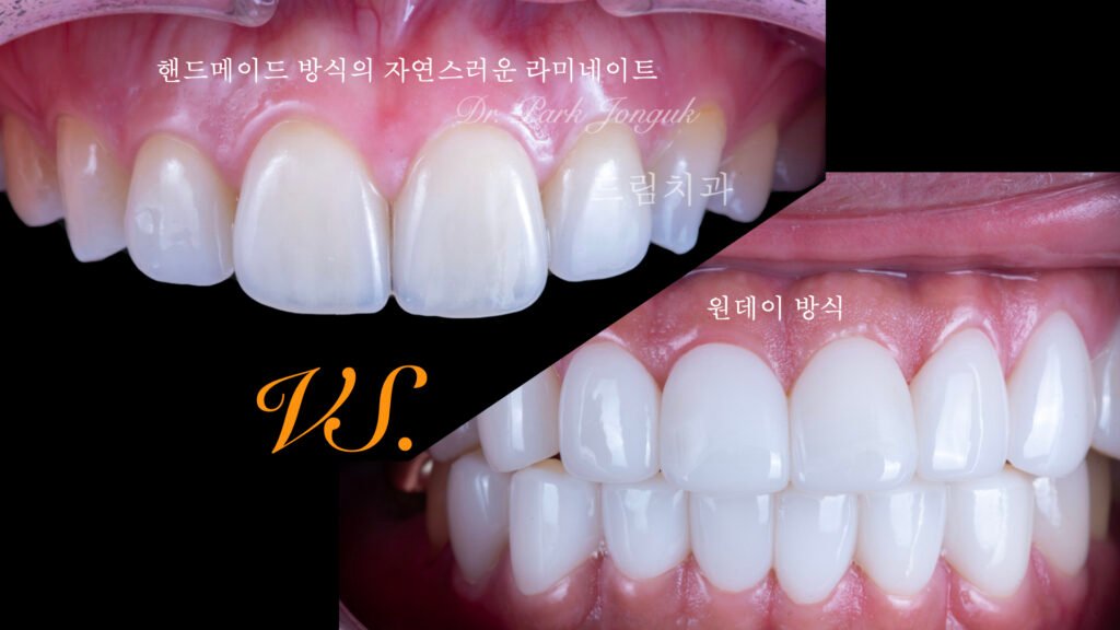 빌드업 라미네이트의 자연스러움과 원데이 라미네이트의 어색함