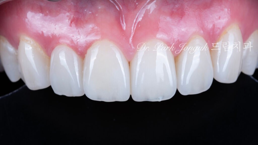 라미네이트 치료 후 8년, 문제 없이 사용중