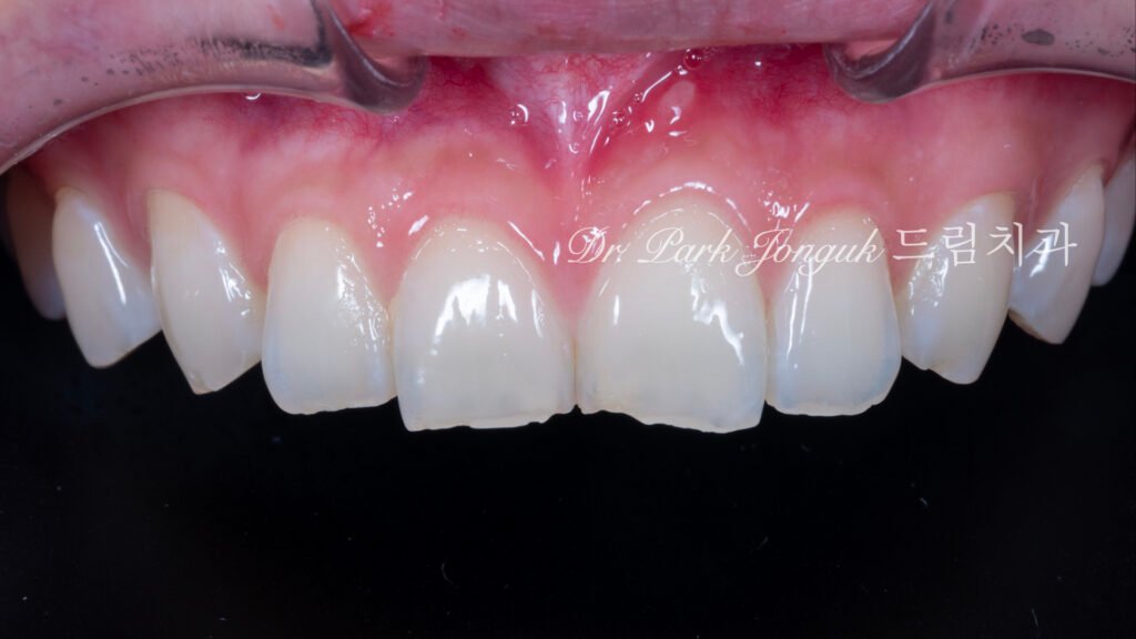 라미네이트 치료를 위해서 내원한 환자.