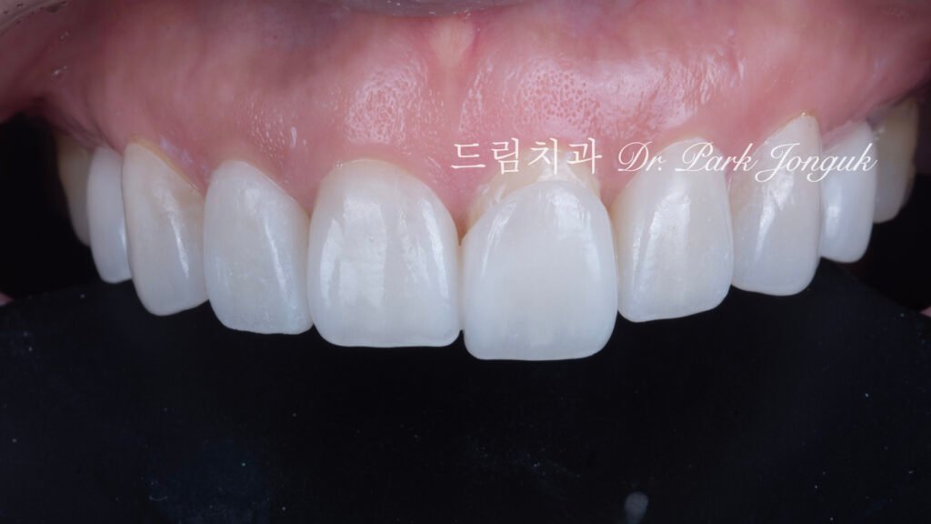 결혼식 직전에 무삭제 라미네이트 치료
