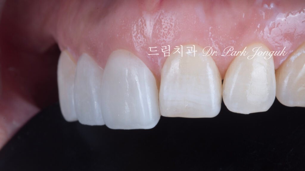 무삭제 라미네이트의 색상 변화