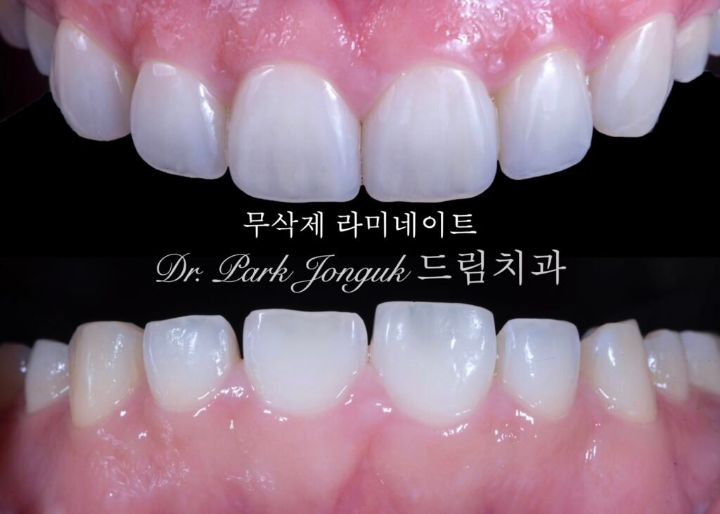 무삭제 라미네이트 전후사진