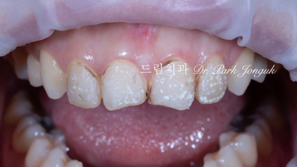 레이저를 이용한 라미네이트 제거