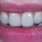 Expert Report, Composite Resin, Porcelain Laminate Veneer, 레진, 라미네이트, 심미수복, Shade Matching, Translucency, 앞니치료, 변색, 내구성, 수명비교