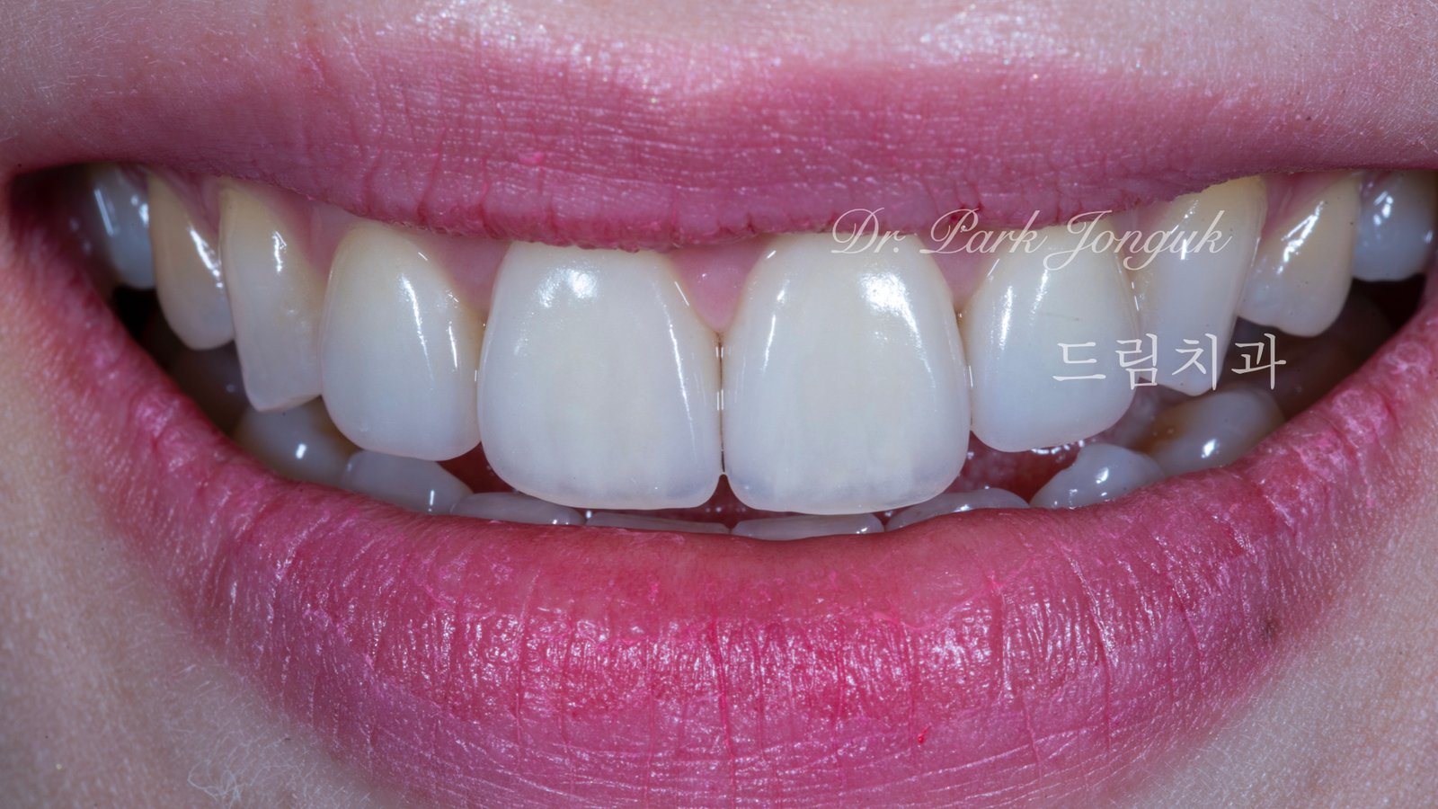 Expert Report, Composite Resin, Porcelain Laminate Veneer, 레진, 라미네이트, 심미수복, Shade Matching, Translucency, 앞니치료, 변색, 내구성, 수명비교