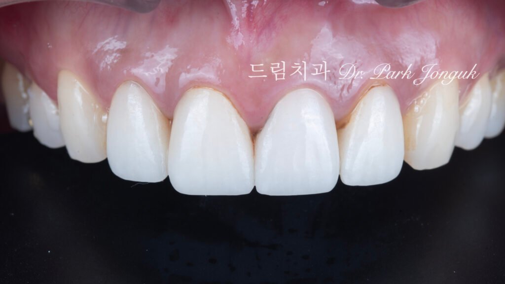 라미네이트 마진 착색