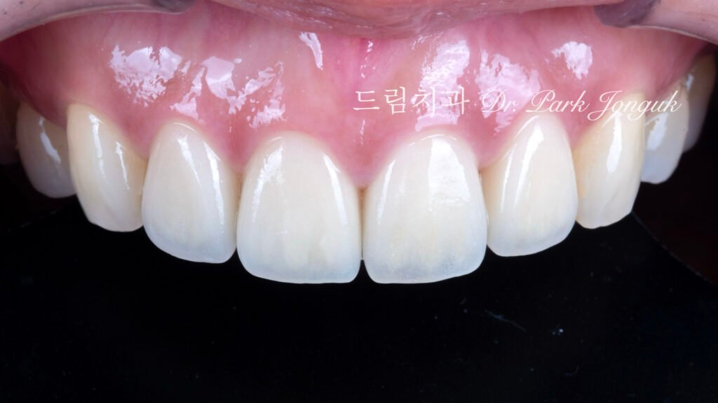 라미네이트 재시술, Laminate Retreatment, 크라운 재시술, Crown Retreatment, 올세라믹 크라운, All-Ceramic Crown, 자연스러운 크라운, Natural Crown, 투명한 라미네이트, Translucent Laminate