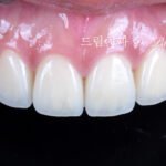 라미네이트 재시술, Laminate Retreatment, 크라운 재시술, Crown Retreatment, 올세라믹 크라운, All-Ceramic Crown, 자연스러운 크라운, Natural Crown, 투명한 라미네이트, Translucent Laminate
