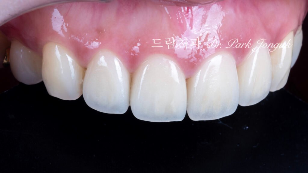 라미네이트 재시술, Laminate Retreatment, 크라운 재시술, Crown Retreatment, 올세라믹 크라운, All-Ceramic Crown, 자연스러운 크라운, Natural Crown, 투명한 라미네이트, Translucent Laminate