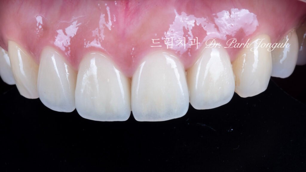 라미네이트 재시술, Laminate Retreatment, 크라운 재시술, Crown Retreatment, 올세라믹 크라운, All-Ceramic Crown, 자연스러운 크라운, Natural Crown, 투명한 라미네이트, Translucent Laminate