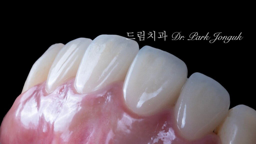라미네이트 재시술, Laminate Retreatment, 크라운 재시술, Crown Retreatment, 올세라믹 크라운, All-Ceramic Crown, 자연스러운 크라운, Natural Crown, 투명한 라미네이트, Translucent Laminate