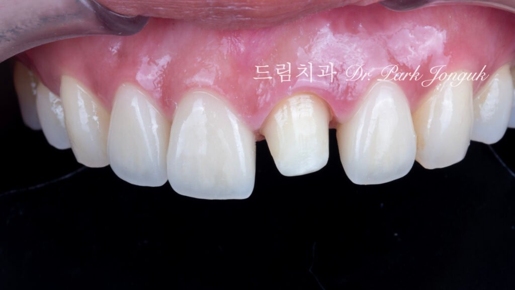 라미네이트 재시술, Laminate Retreatment, 크라운 재시술, Crown Retreatment, 올세라믹 크라운, All-Ceramic Crown, 자연스러운 크라운, Natural Crown, 투명한 라미네이트, Translucent Laminate