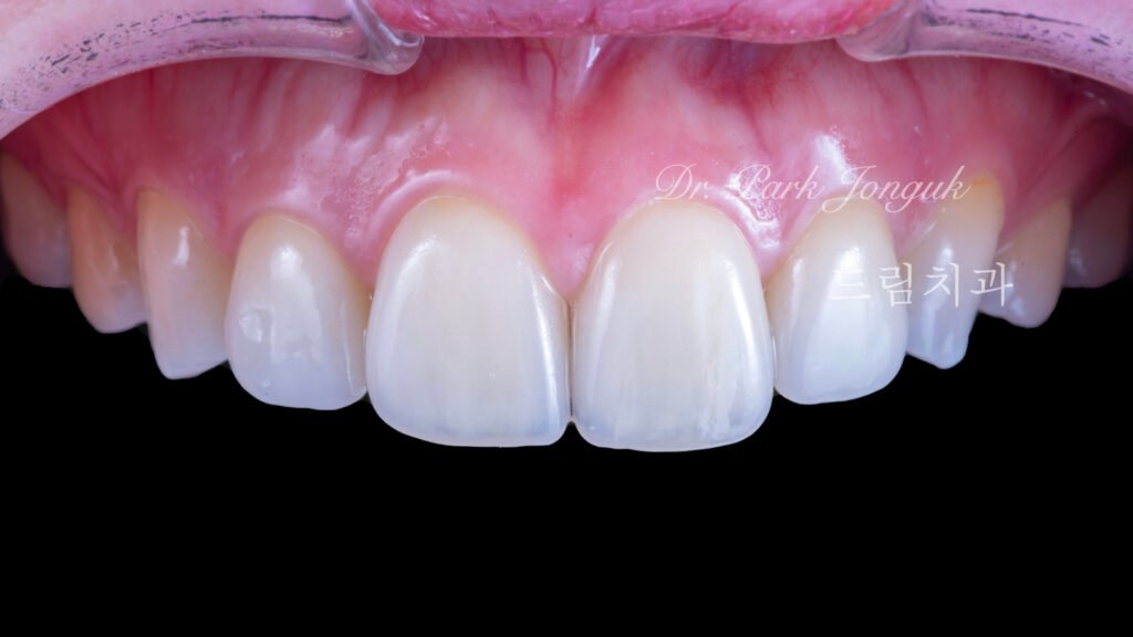 장기간 유지된 라미네이트