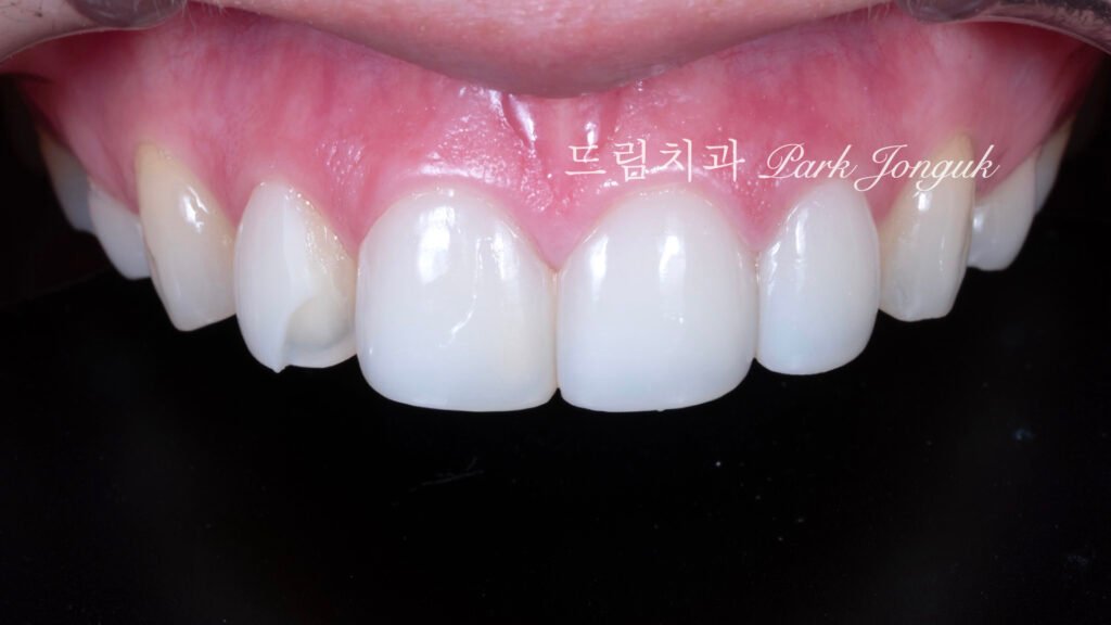 라미네이트 파절