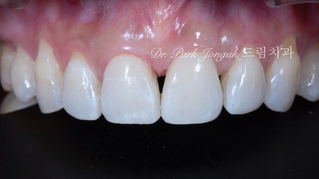 블랙 트라이앵글, Black Triangle, 블랙 트라이앵글 치료, Black Triangle Treatment, 블랙 트라이앵글 라미네이트, 교정 후 블랙 트라이앵글, Post-Orthodontic Black Triangle, 무삭제 라미네이트, No-Prep Laminate