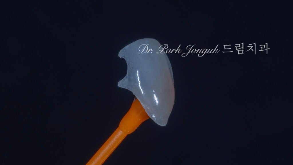 블랙 트라이앵글, Black Triangle, 블랙 트라이앵글 치료, Black Triangle Treatment, 블랙 트라이앵글 라미네이트, 교정 후 블랙 트라이앵글, Post-Orthodontic Black Triangle, 무삭제 라미네이트, No-Prep Laminate